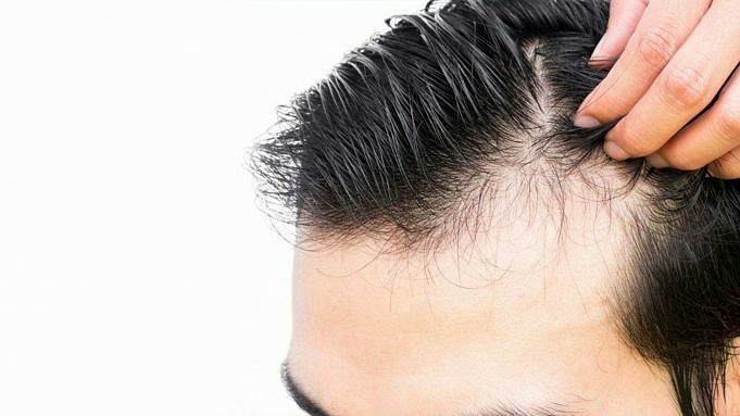 Haarverlies Bij Mannen. Alles Wat U Moet Weten